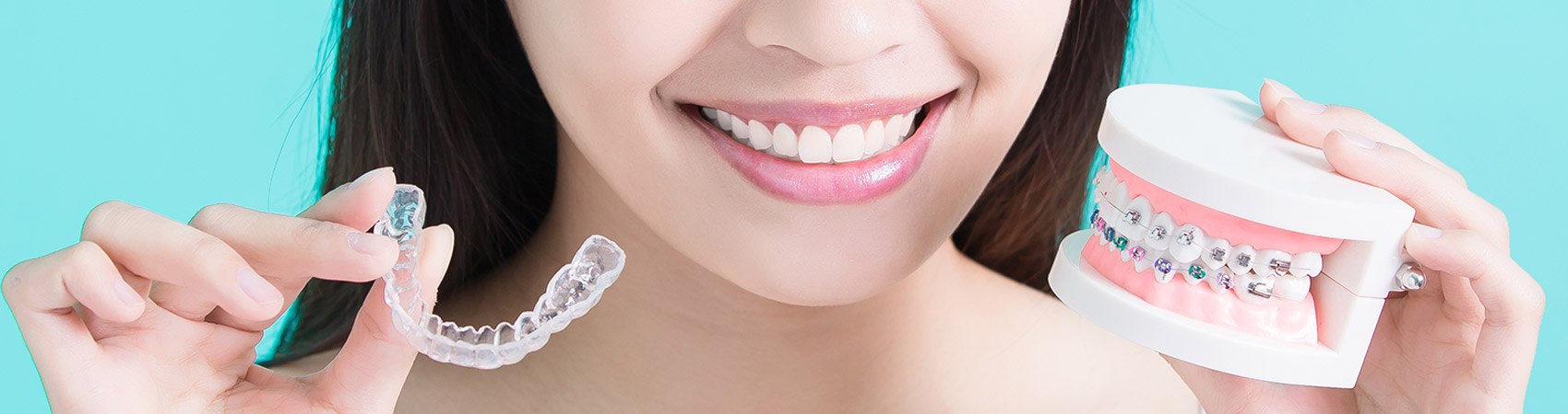 Clear Aligners - Kenner Dental Group
