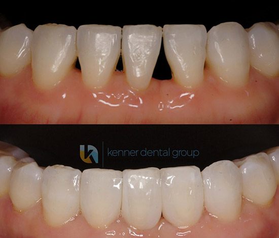The Dental House - BONDING GAPS WITH COMPOSITE RESIN. IT IS USED TO CLOSE  SPACES BETWEEN TEETH.. Our dental practice offers high-end Cosmetic  Dentistry including Cosmetic Composite Tooth bonding. We pay close